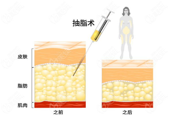 吸脂失敗修復(fù)醫(yī)生有哪些