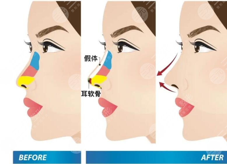 贵州省人民医院做鼻子怎么样