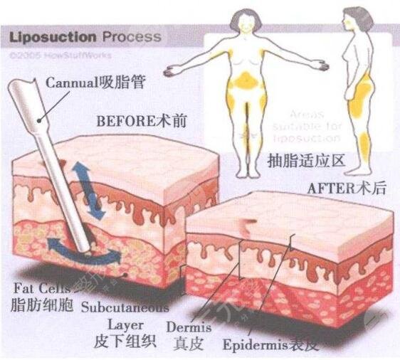 北京金圣医疗整形医院腹部吸脂手术怎么样、多少钱