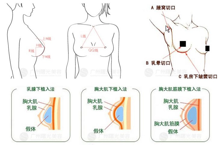 长沙爱思特隆胸怎么样 多少钱