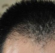 頭發(fā)少可以植發(fā)嗎