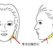 上海伊萊美李湘原磨骨怎么樣?磨骨多少錢?