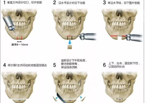 北京联合丽格做下颌角颧骨哪个医生好