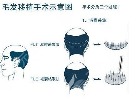 深圳北大医院植发挂什么科