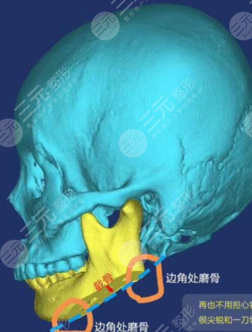 九院磨骨手术流程反馈