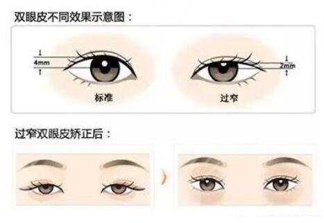 北京济华医美医院双眼皮修复整形价目表新鲜出炉