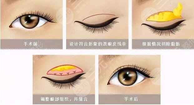 重庆铜雀台的双眼皮手术做得怎么样