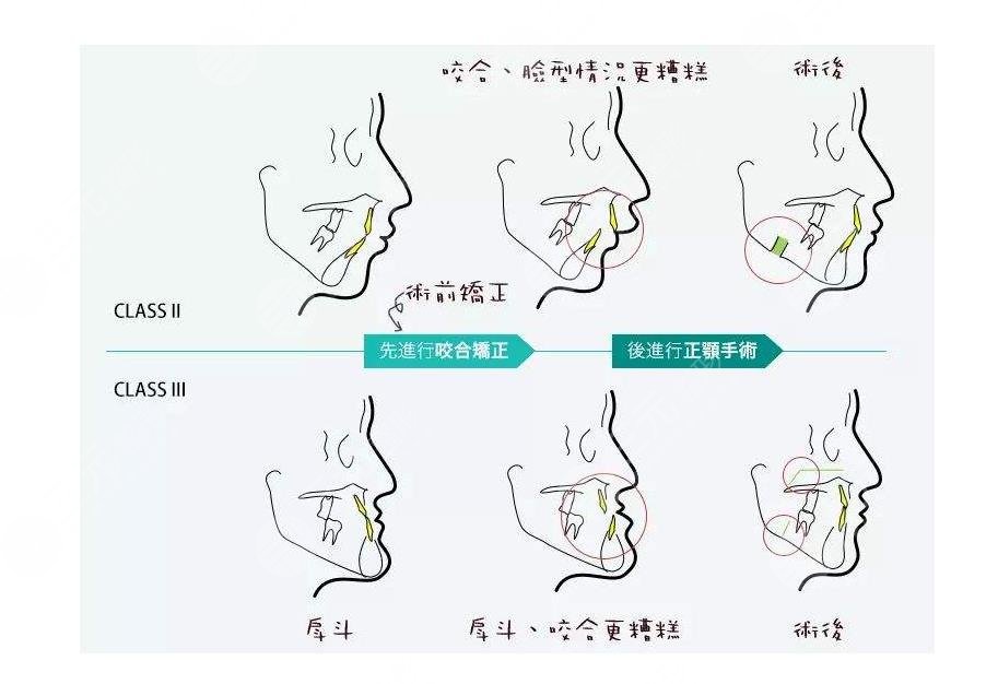 南方医院正颌手术怎么样