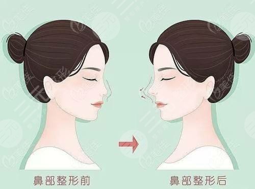 上海百达丽医疗美容隆鼻整形详细价格表公开