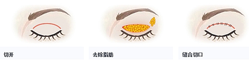 杭州时光整形医院做双眼皮怎么样 多少钱