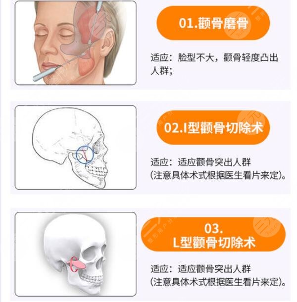北京下颌角整形去哪个医院