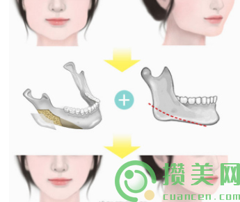 成都友谊赵延峰下颌角