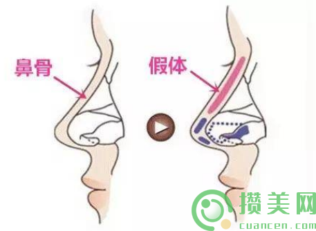 广州荔医隆鼻整形