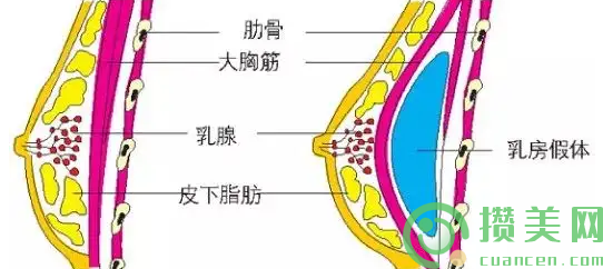 上海时光李静林胸整形