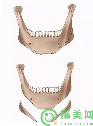 武汉中翰下颌角截骨示意图