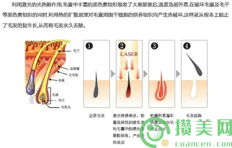 激光脱毛原理