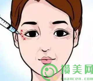 注射除眼角纹