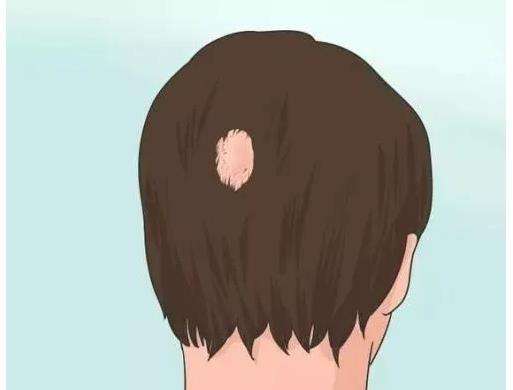 头上有烫伤疤痕植发需要多少钱？