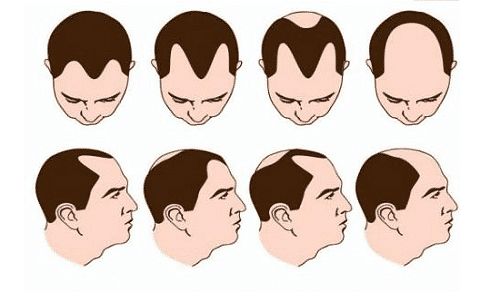 脱发如何防治？治疗脱发的方法有哪些？