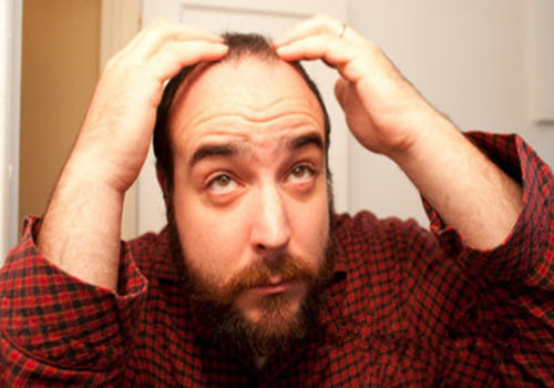 脂溢性脱发只发生在男性？别搞笑了~