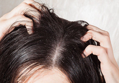 脂溢性脱发患者需要每天洗头吗？