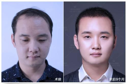 北京种植头发：M型脱发额角植发多少钱？