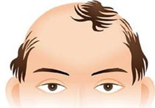休止期脱发的特征有哪些？