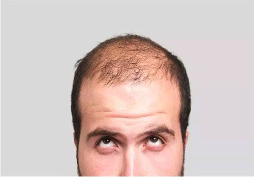 精神性脱发和脂溢性脱发的区别在哪里？