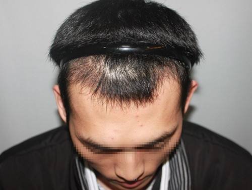 北京种植额角毛发需要多少钱？