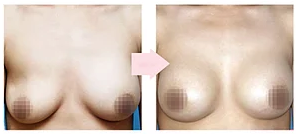 提乳手术的方法有哪些？