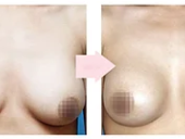 提乳手术的方法有哪些？