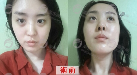 在上海九院整形外科医院做的正颌手术，恢复很好，现在