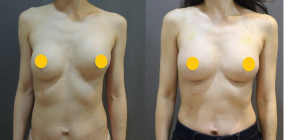 隆胸重做手术的方式有哪几种?