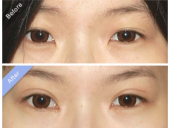 做全切双眼皮术后淤青肿胀疤痕怎么护理？