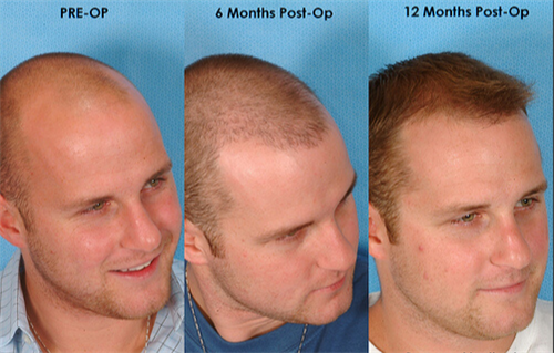 毛发移植后的生长过程