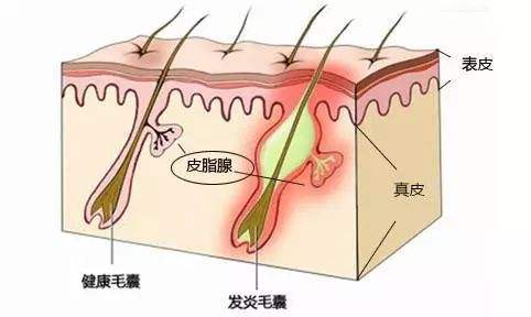 取发区毛囊炎多久才好