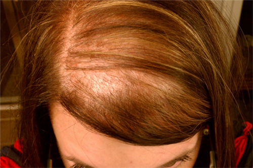 女性脂溢性脱发有救吗