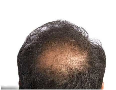 脂溢性脱发的症状是什么呢