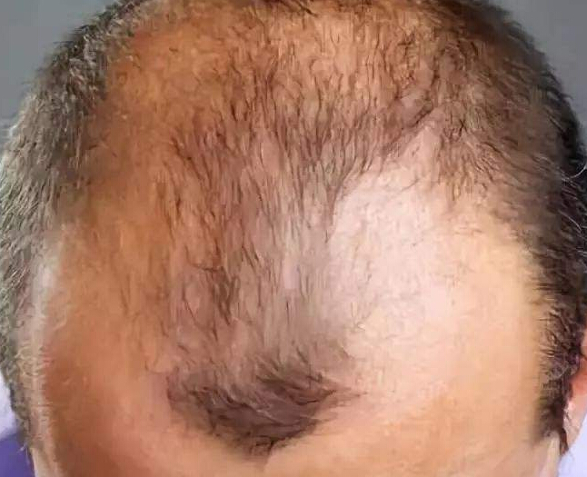雄性脱发的三个阶段症状是怎样的