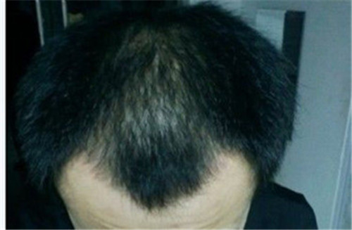 脂溢性脱发和遗传有关系吗？