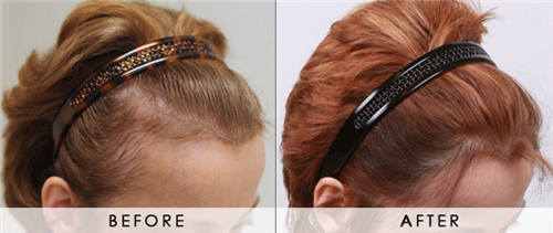 三种恢复女性脱发的方法