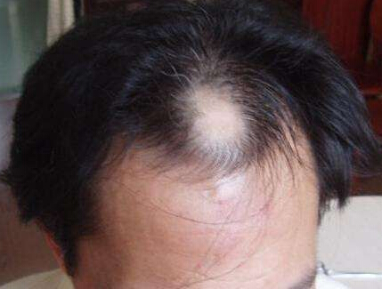 预防男性脱发的发生，要怎么做