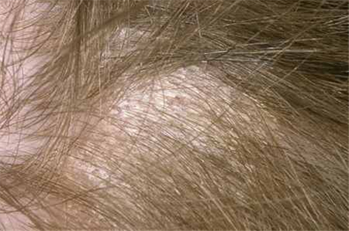 头皮干燥会导致脱发吗