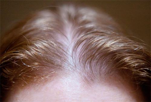 如何防止头发稀疏