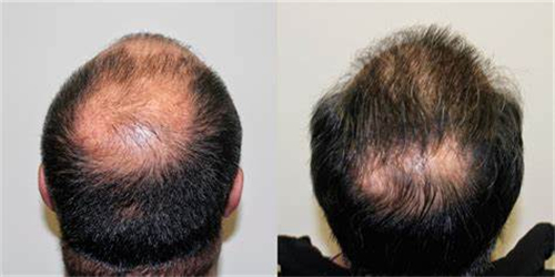 几种治疗头发稀疏和脱发的方法