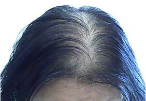 慢性脂溢性脱发的症状有哪些