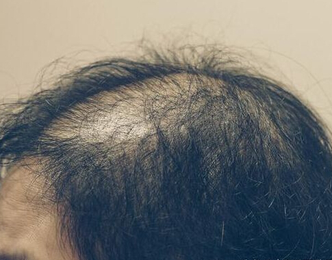 脂溢性脱发的临床表现有哪些