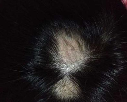 瘢痕性脱发的发病原因是什么