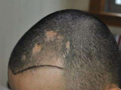 瘢痕性脱发的发病原因是什么