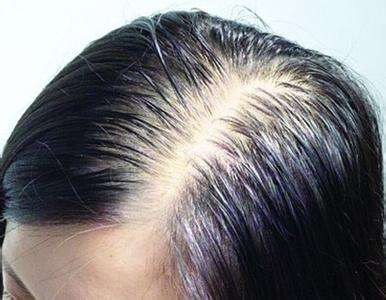 脂溢性脱发的出现和什么原因有关